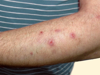 Avanços no Tratamento: Enfrentar o Desafio da Dermatite Atópica (DA) e do Prurigo Nodular (PN) não controlados