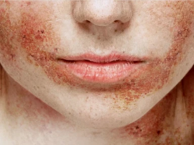 Alguns números sobre a Dermatite Atópica