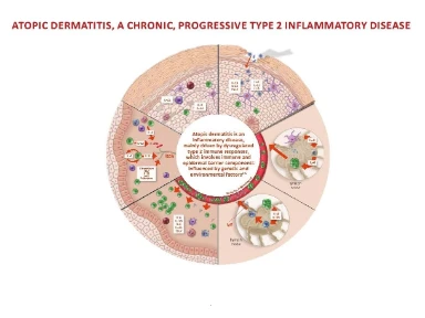 Atopic Dermatitis Pathophysiology: Breaking Down the Barrier