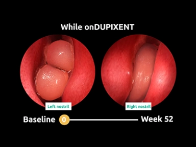 NPS improvement with Dupixent over time