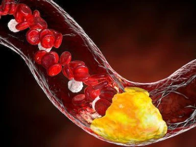 Is Clopidogrel a viable first choice P2Y12 inhibitor for DAPT after PCI?