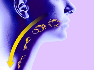 Measures of disease severity in eosinophilic esophagitis (EoE)