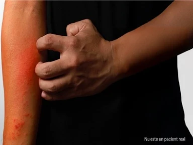 Îmbunătățirea calității vieții la pacienții cu dermatită atopică (DA) necontrolată: Instrumente pentru identificarea și tratamentul la timp