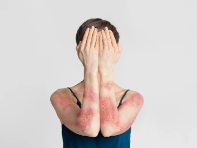 Impactul ascuns al afectării cumulative pe parcursul vieții (CLCI) în dermatologie: Prezentare generală