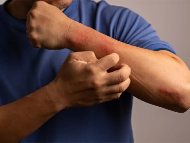 Povara invizibilă: Cum afectează afectarea cumulativă pe parcursul vieții (CLCI) pacienții cu dermatită atopică (DA) moderată până la severă 