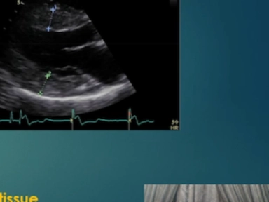 Fabry Disease from Cardiology Perspective