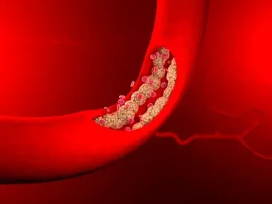 The European experience: Swedeheart and AIFA registries