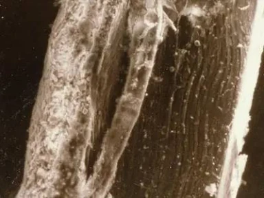 Acute Medical Illness: Advanced Age Alone Predicts Venous Thromboembolism Similar to Existing Risk Assessment Models