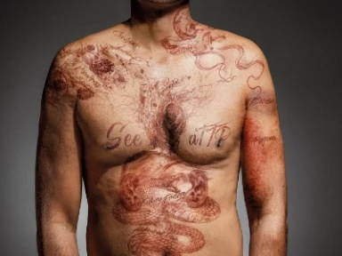 aTTP (förvärvad trombotisk trombocytopen purpura)