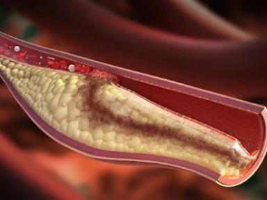 ESC 2020: Antiplatelet Tedavide Mevcut Trendler