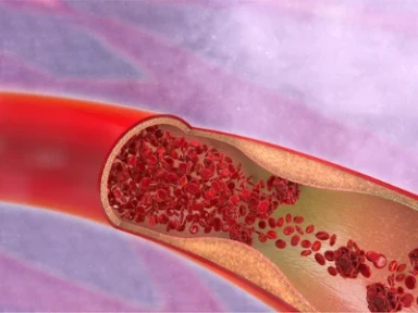 Embolik Olaylar ve Risk Yönetimi