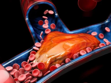 Pulmoner Emboli ve Varfarin Etkisi