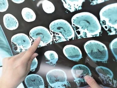 İskemik İnme'de Tedavi'nin Devamı