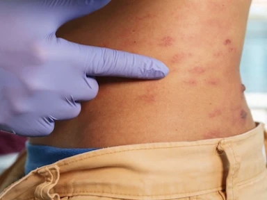 IMD Survivor Complications