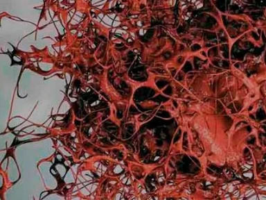 O que é o Mieloma Múltiplo?