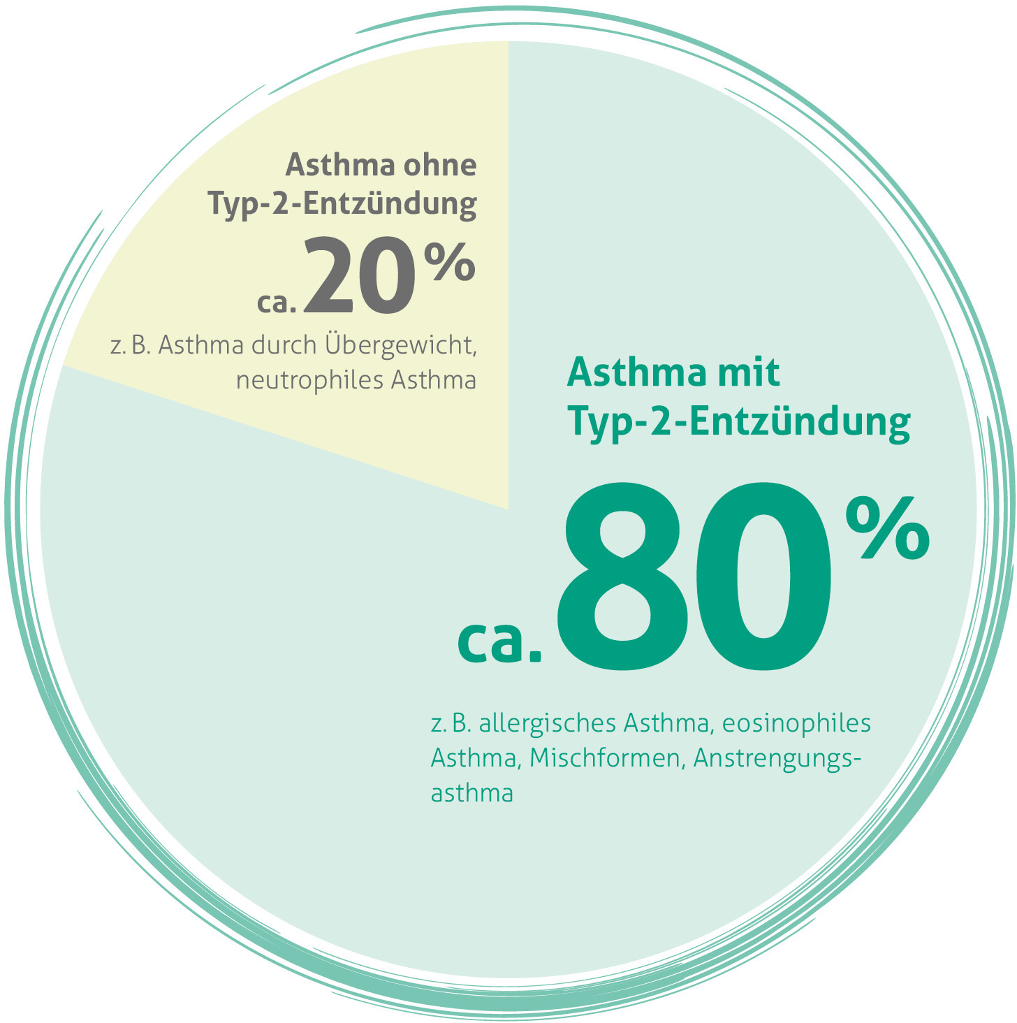 Kreisdiagramm zur Verteilung von Asthma-Typen: 80% ist Asthma mit Typ-2-Entzündung (einschließlich allergisches Asthma, eosinophiles Asthma, Mischformen und Anstrengungsasthma) und 20% ist Asthma ohne Typ-2-Entzündung (einschließlich Asthma durch Übergewicht und neutrophiles Asthma).