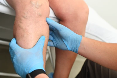 Medizinische Untersuchung eines Beins mit sichtbaren Venen, durchgeführt von einem Pfleger mit blauen Handschuhen.
