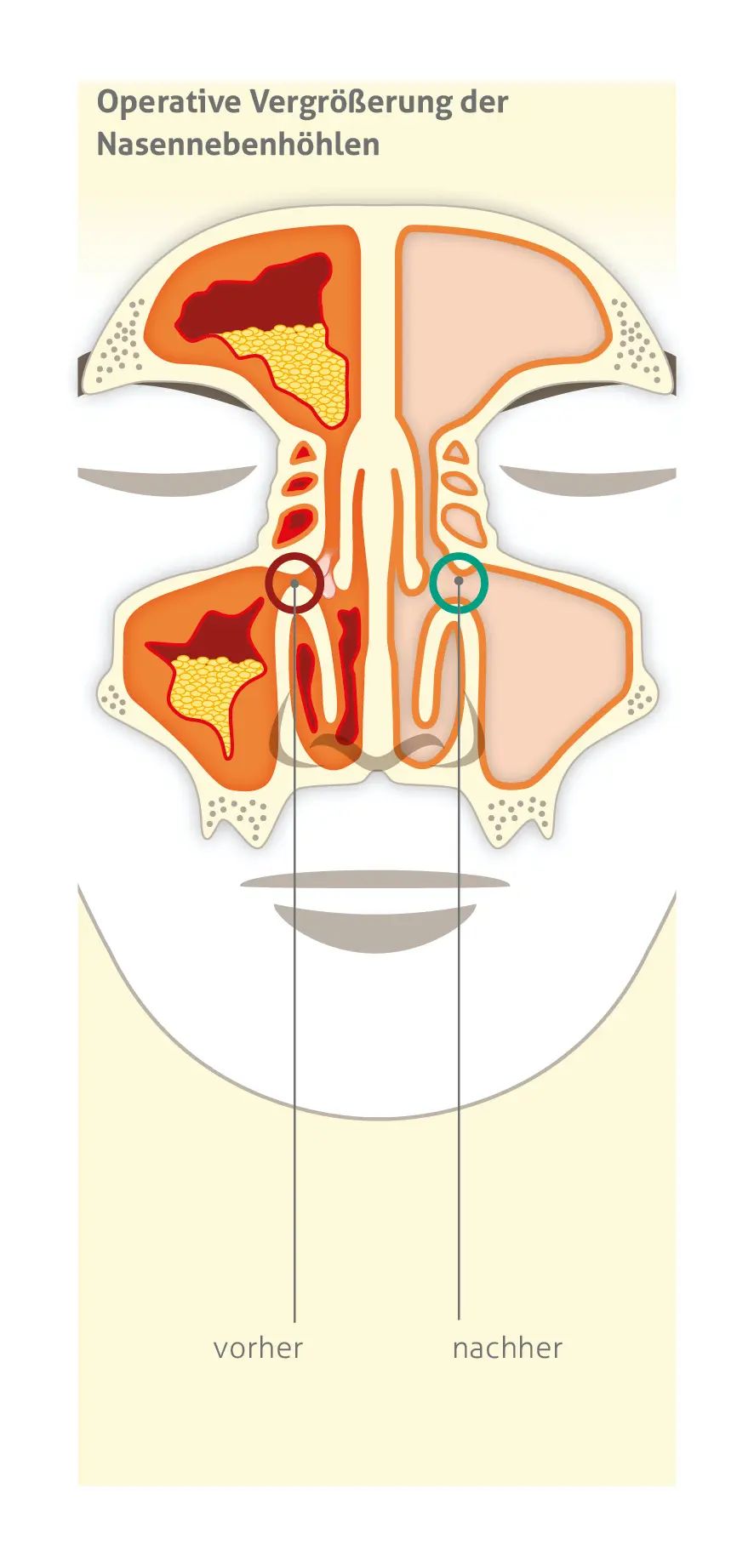 Anatomische Illustration der operativen Eröffnung der Nasennebenhöhlen mit Vorher-Nachher-Vergleich. Die linke Seite zeigt verengte, mit Schleim gefüllte Nebenhöhlen vor der Operation, während die rechte Seite erweiterte, offenere Nebenhöhlen mit verbessertem Luftstrom nach dem Eingriff darstellt. Der Bereich des chirurgischen Eingriffs ist mit einem grünen Kreis hervorgehoben.