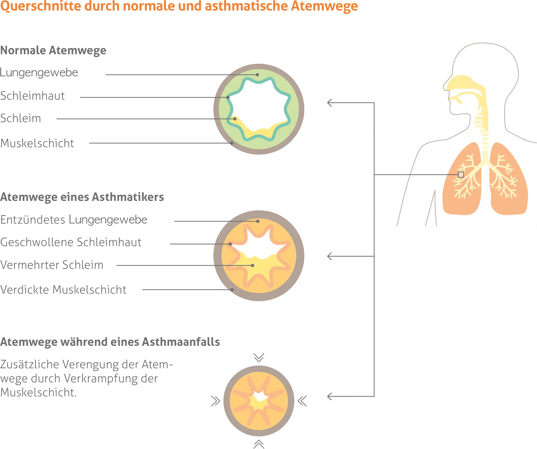 Diagramm mit Querschnitten normaler und asthmatischer Atemwege. Zeigt drei Stadien: 1) Normale Atemwege mit regulärem Bronchialgewebe, Schleimhaut, Schleim und Muskelschicht; 2) Atemwege eines Asthmatikers mit entzündetem Bronchialgewebe, geschwollener Schleimhaut, vermehrtem Schleim und verdickter Muskelschicht; 3) Atemwege während eines Asthmaanfalls mit zusätzlicher Verengung durch Verkrampfung der Muskelschicht.