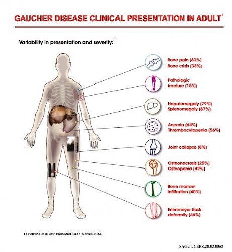How To Diagnose Gaucher Disease