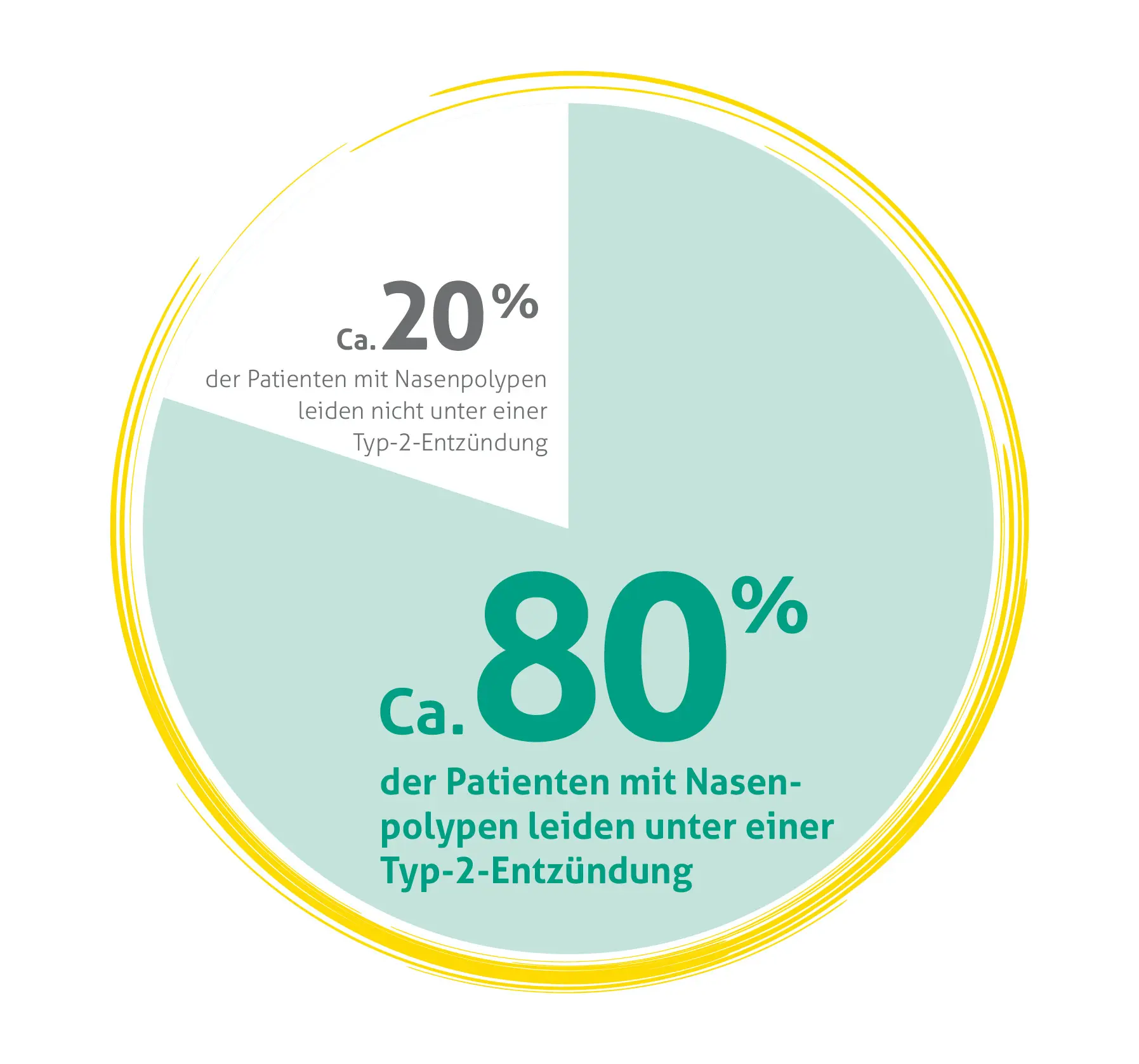 Kreisdiagramm zur Verteilung von Patienten mit Nasenpolypen: Ein größeres hellblaues Segment zeigt, dass ca. 80% der Patienten mit Nasenpolypen unter einer Typ-2-Entzündung leiden. Ein kleineres weißes Segment zeigt, dass ca. 20% der Patienten mit Nasenpolypen nicht unter einer Typ-2-Entzündung leiden.