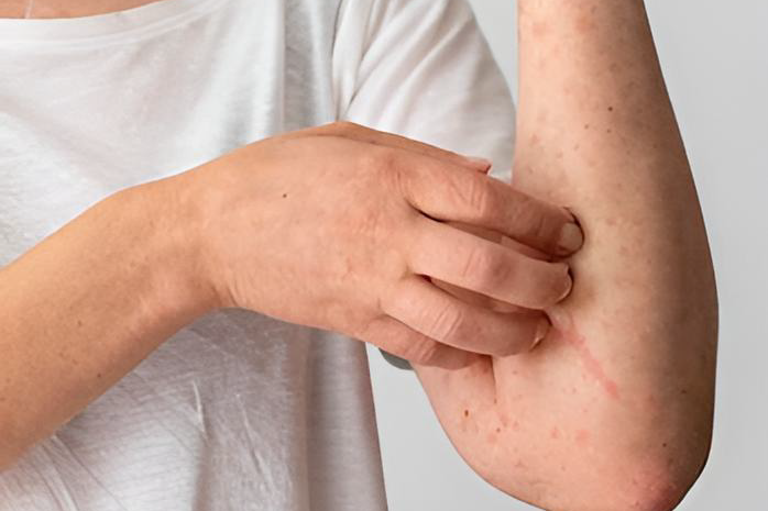 Atopic Dermatitis