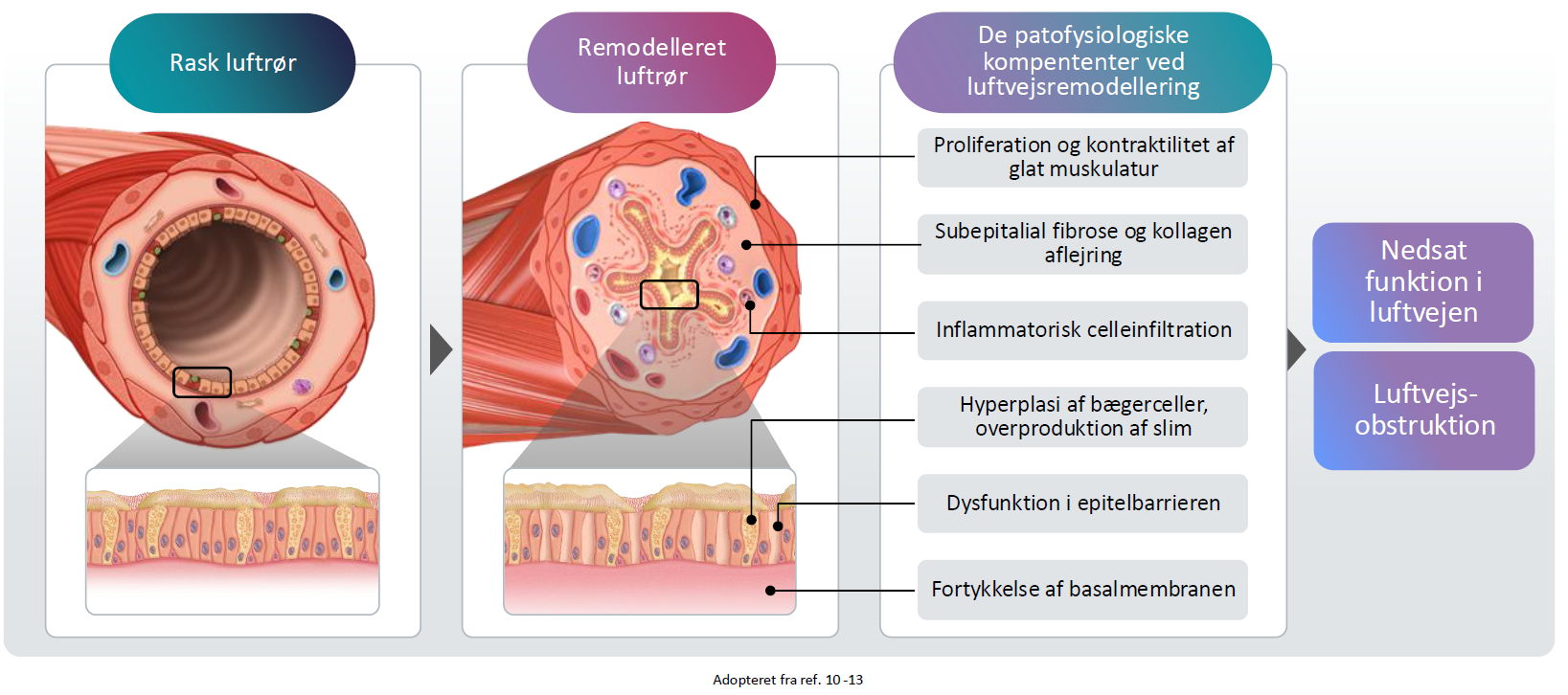 Remodeling in asthma comprises structural changes to the airways
