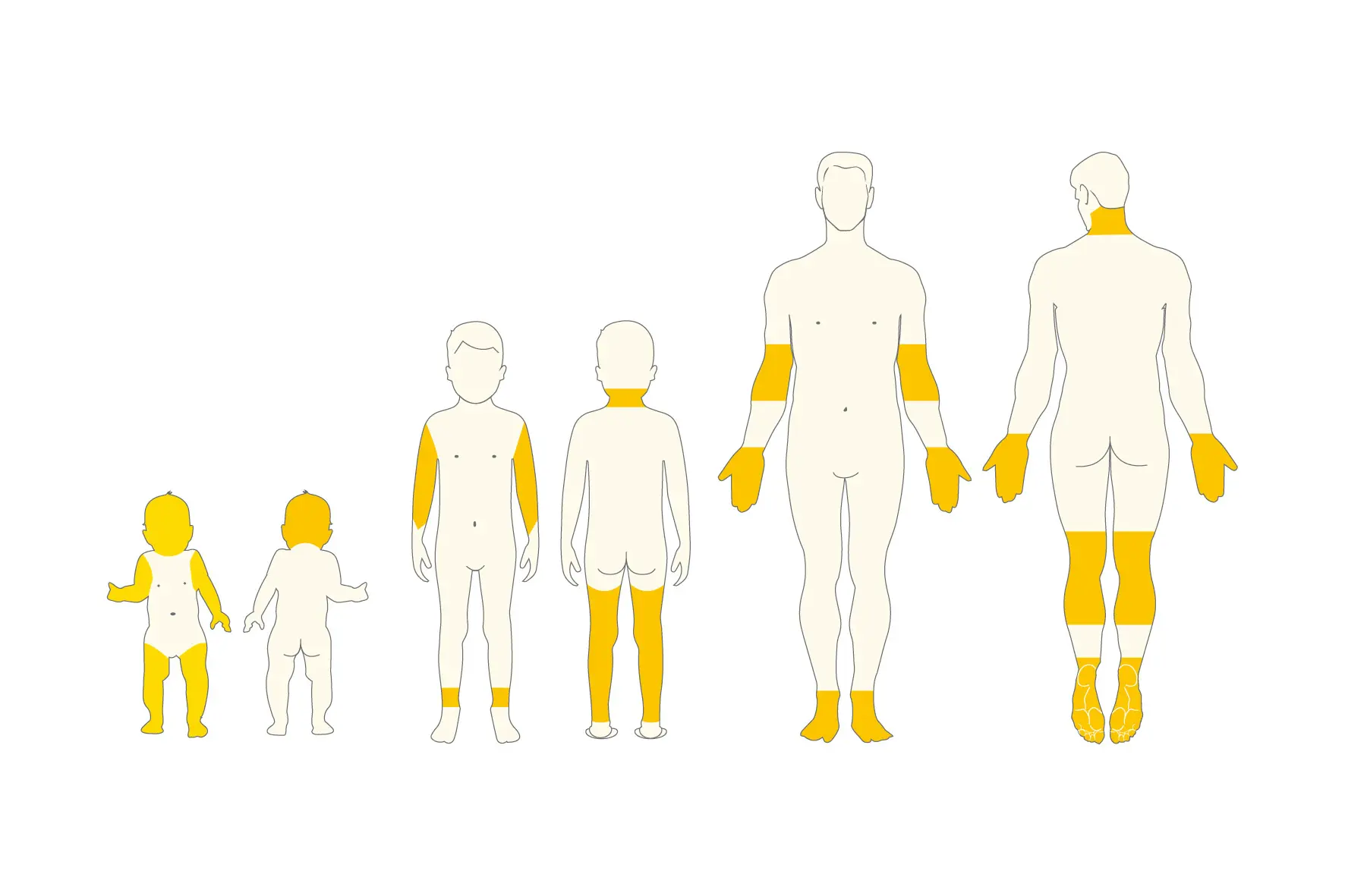 Diagramm zur Darstellung der Körperoberfläche (BSA) über sechs Altersgruppen vom Säugling bis zum Erwachsenen. Jede menschliche Figur ist gelb schattiert, um den Anteil der betroffenen Körperoberfläche in verschiedenen Entwicklungsstadien anzuzeigen, wobei die betroffene Fläche bei Säuglingen im Verhältnis zu Erwachsenen prozentual größer ist, auch wenn die absolute Fläche mit dem Körperwachstum zunimmt.