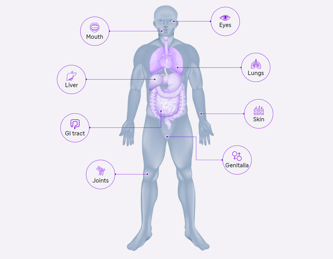 Organ to know more about cGVHD 
