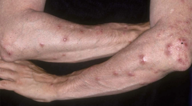 derma-pn
