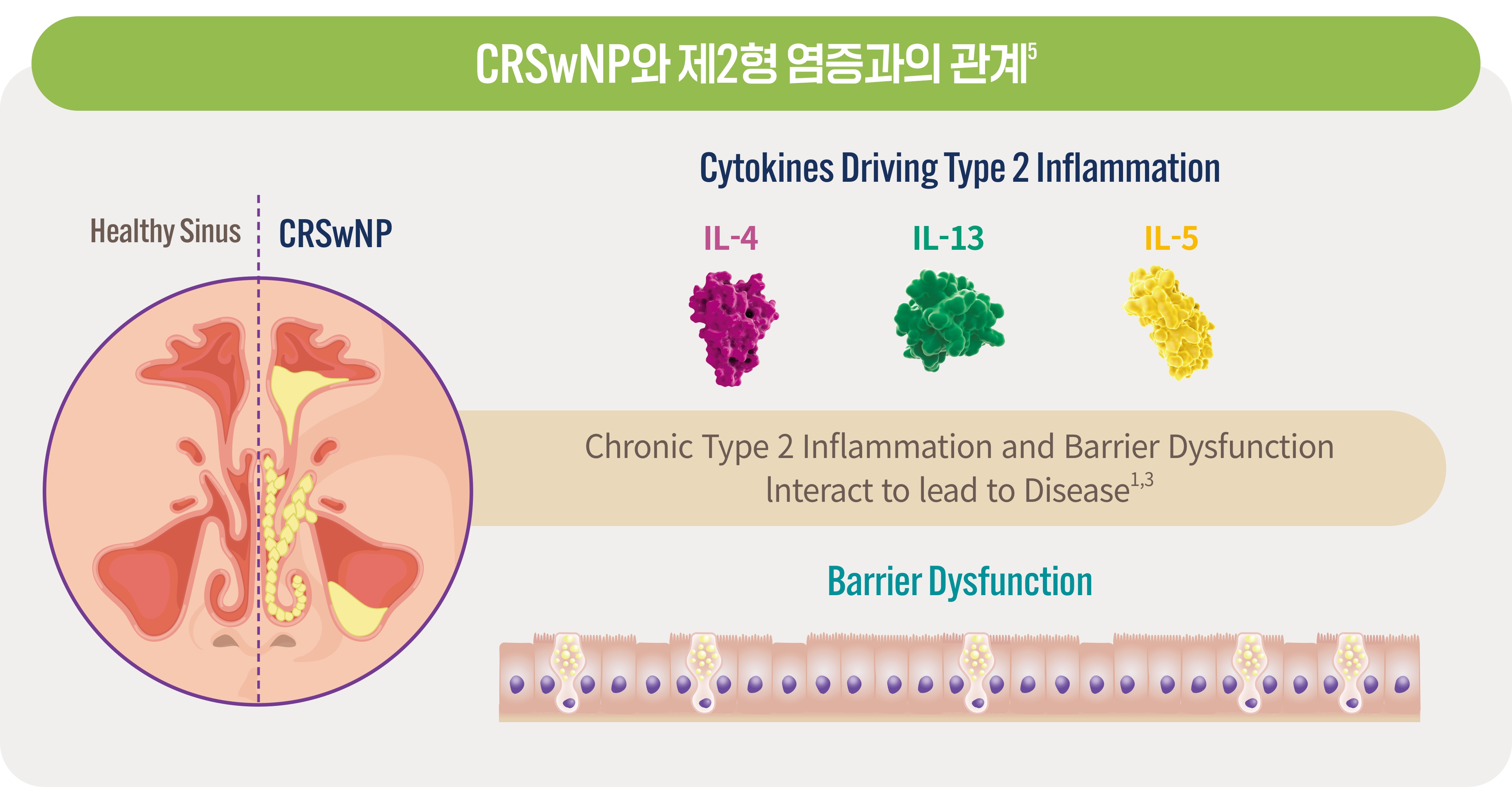 비용종을 동반한 만성 비부비동염과 제2형 염증