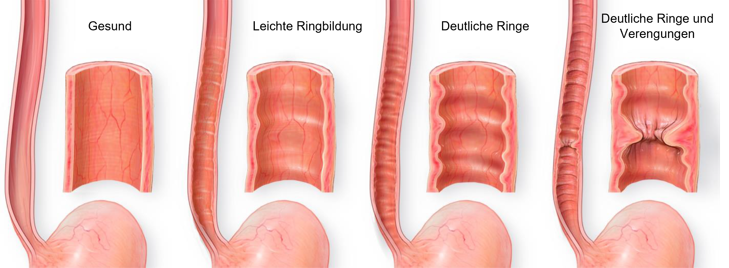 Infografik zur eosinophilen Ösophagitis mit vier Bildern, die den Krankheitsverlauf von gesunder Speiseröhre über Ringbildung bis hin zu Verengungen zeigt, mit begleitendem Text zu Symptomen und Ursachen.