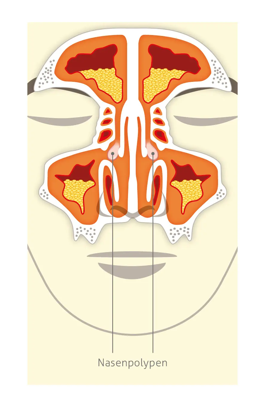 Medizinische Illustration eines Querschnitts durch Nase und Nasennebenhöhlen, die beidseitige Nasenpolypen zeigt. Die Polypen blockieren die Luftwege. Es wird gelblicher Schleimüberschuss symmetrisch in den orangefarbenen Nasennebenhöhlen dargestellt. Die entzündete geschwollene Schleimhaut ist dunkelrot umrandet.Am unteren Bildrand steht der der Text "Nasenpolypen".