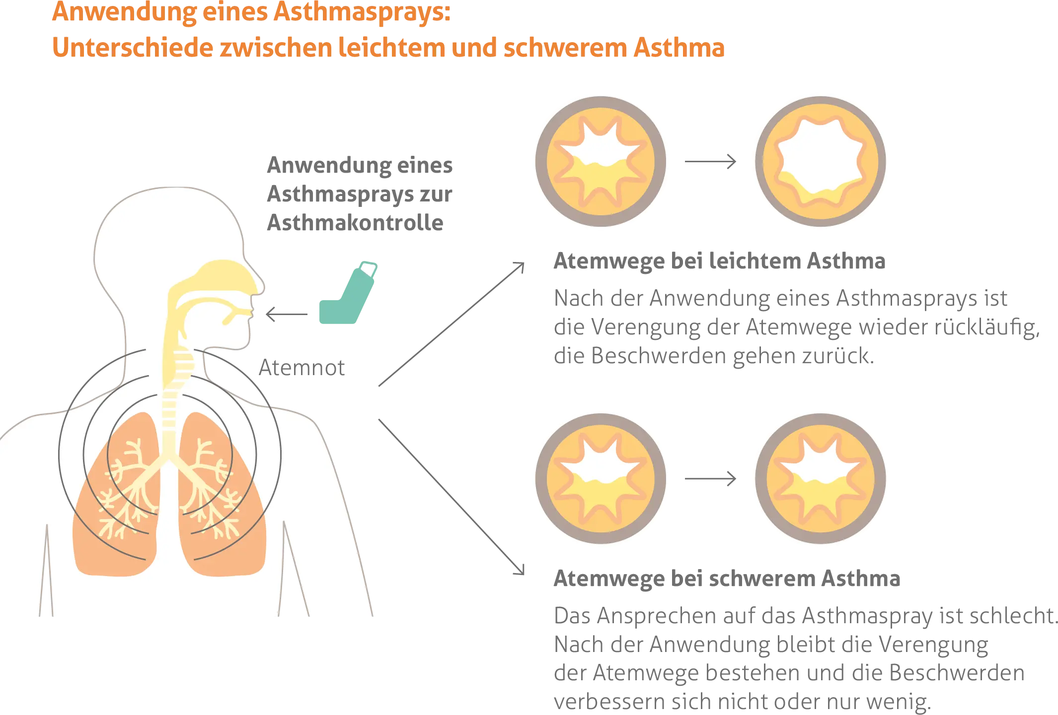 Diagramm zum Vergleich der Wirksamkeit eines Asthmasprays bei leichtem versus schwerem Asthma. Zeigt eine menschliche Figur, die einen Inhalator benutzt, mit zwei Sätzen von Atemwegsdarstellungen. Bei leichtem Asthma: Atemwege erweitern sich deutlich nach Anwendung des Sprays, Beschwerden gehen zurück. Bei schwerem Asthma: Atemwege bleiben nach Anwendung des Sprays verengt mit geringer oder keiner Verbesserung der Symptome. Titel lautet 'Anwendung eines Asthmasprays: Unterschiede zwischen leichtem und schwerem Asthma.'