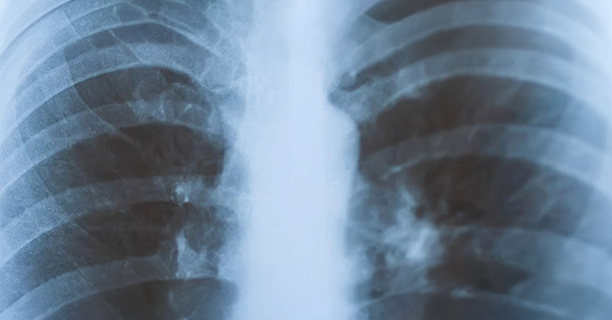 x-ray